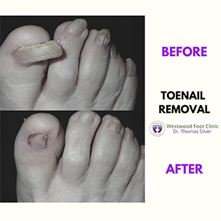 ToenailRemoval1