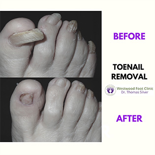 Thickened Toenails - Foot Clinic